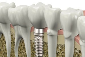 Am I a good candidate for dental implants?