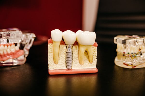 Why do dental implants cost so much?