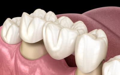 Why choose dental implants instead of a dental bridge?