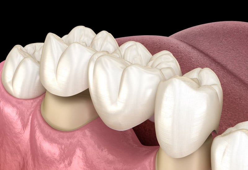 Why choose dental implants instead of a dental bridge?