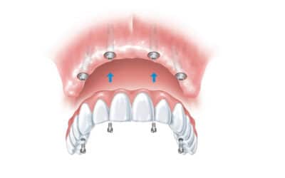 A simplified guide to the dental implant procedure