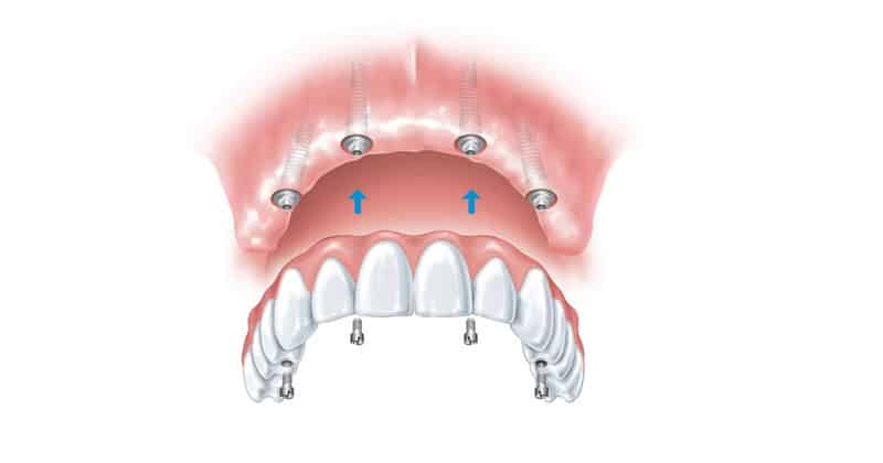 A simplified guide to the dental implant procedure