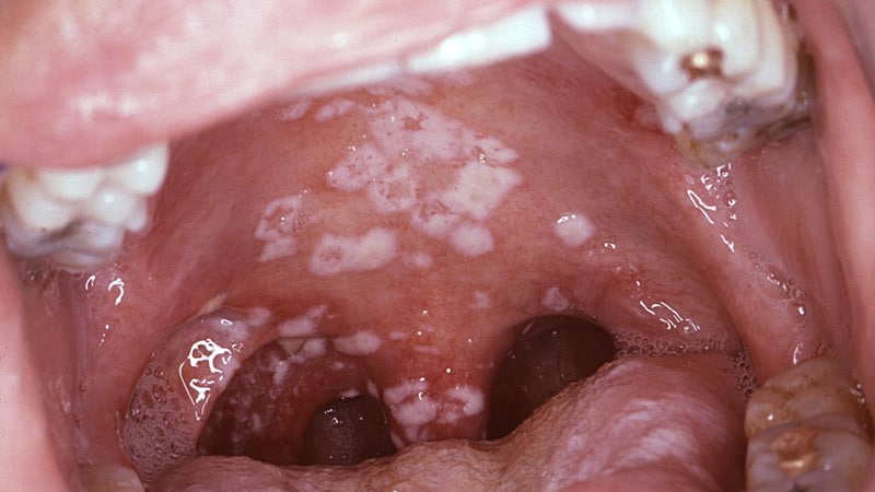 White spots in the mouth