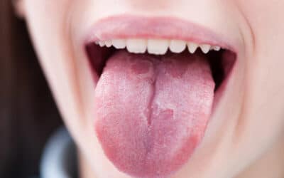 What causes tongue discolouration?