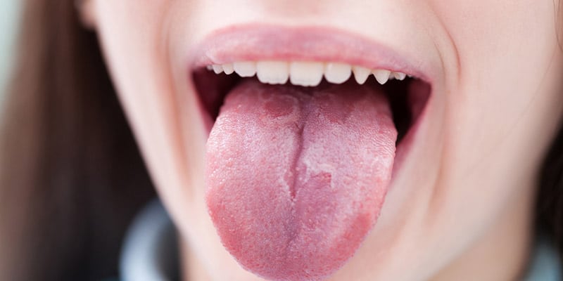 Tongue discolouration