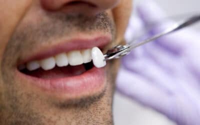 Can dental veneers be used to treat white spots?