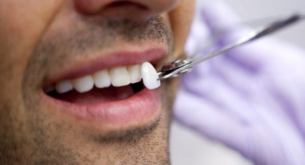 Can dental veneers be used to treat white spots?