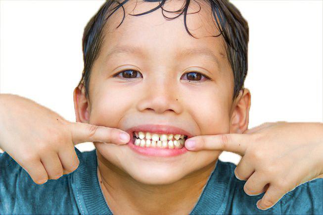 Image of child with white-spot on teeth