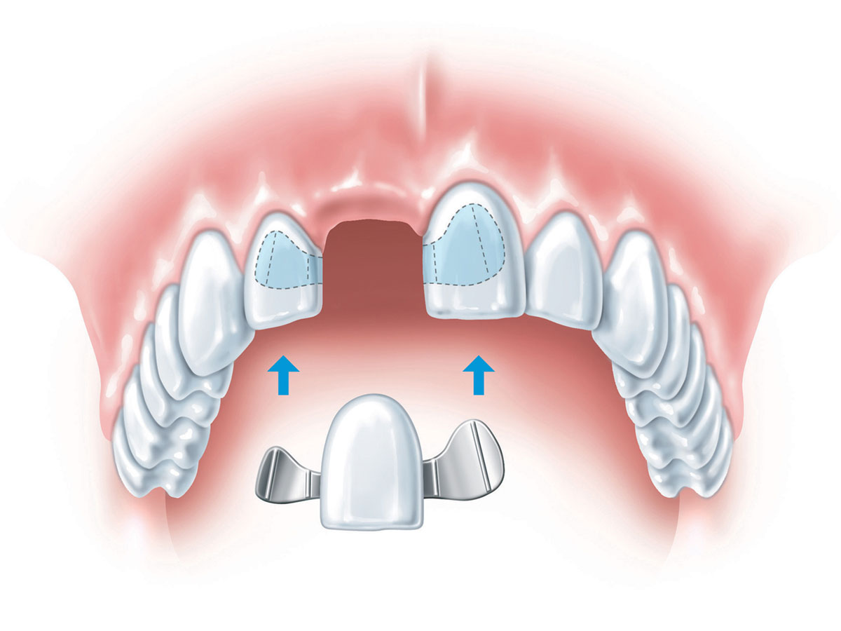 Имплантация 4 передних зуба для имплантации
