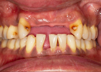 Image showing final stage of gum disease