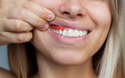 Gum Disease and Dental Implants: Key Things to Know