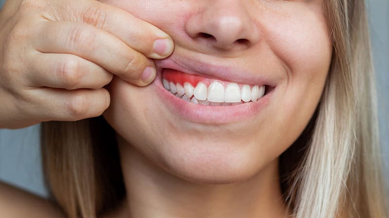 Gum Disease and Dental Implants: Key Things to Know